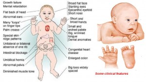 clinical features of downs syndrome