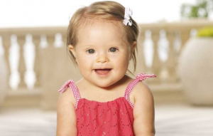 downs syndrome facial features