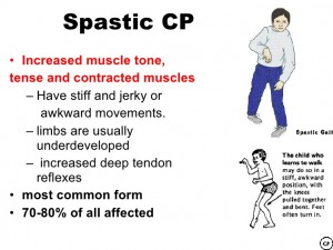 spastic CP